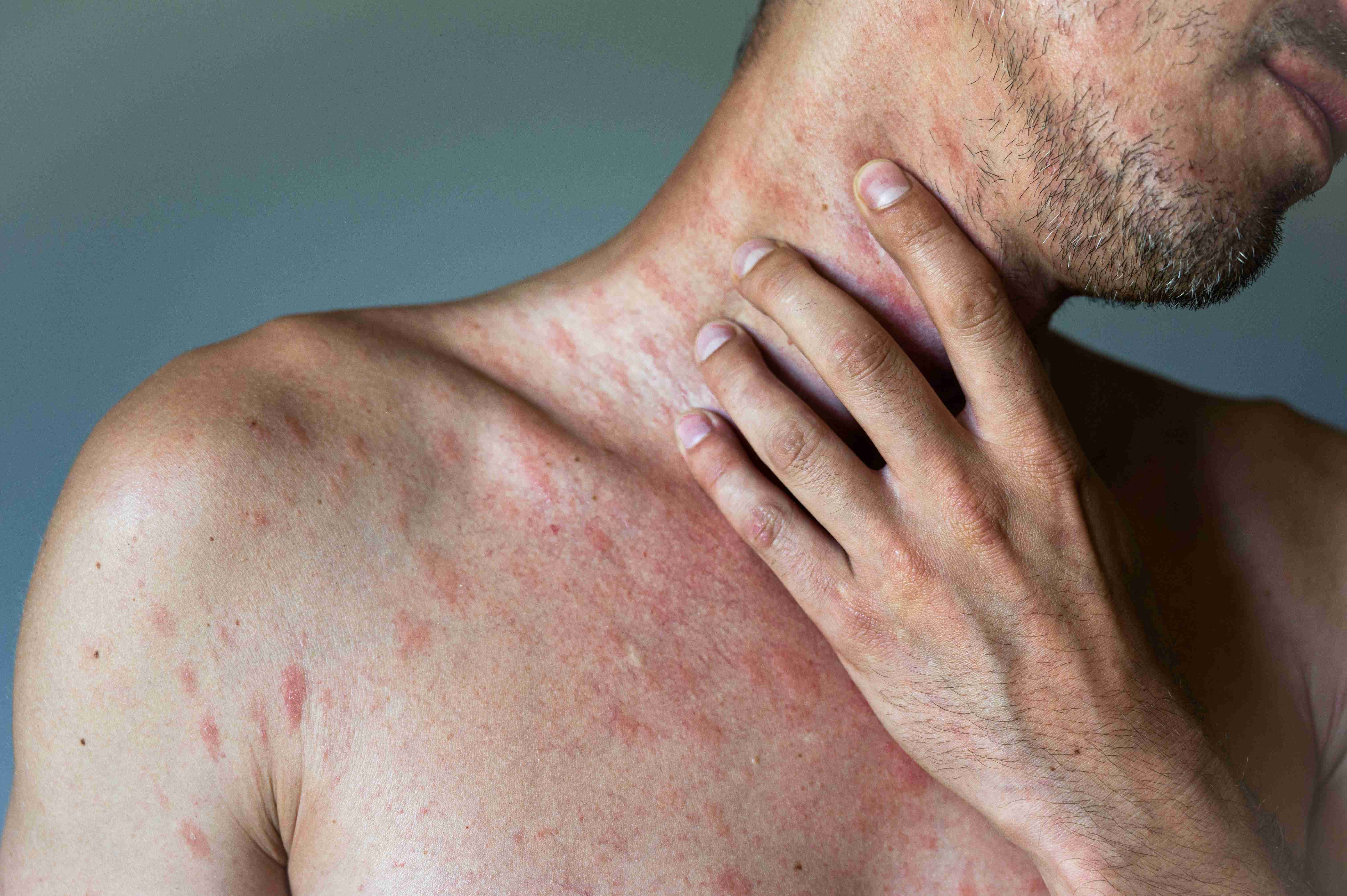 Hives and swelling on the skin