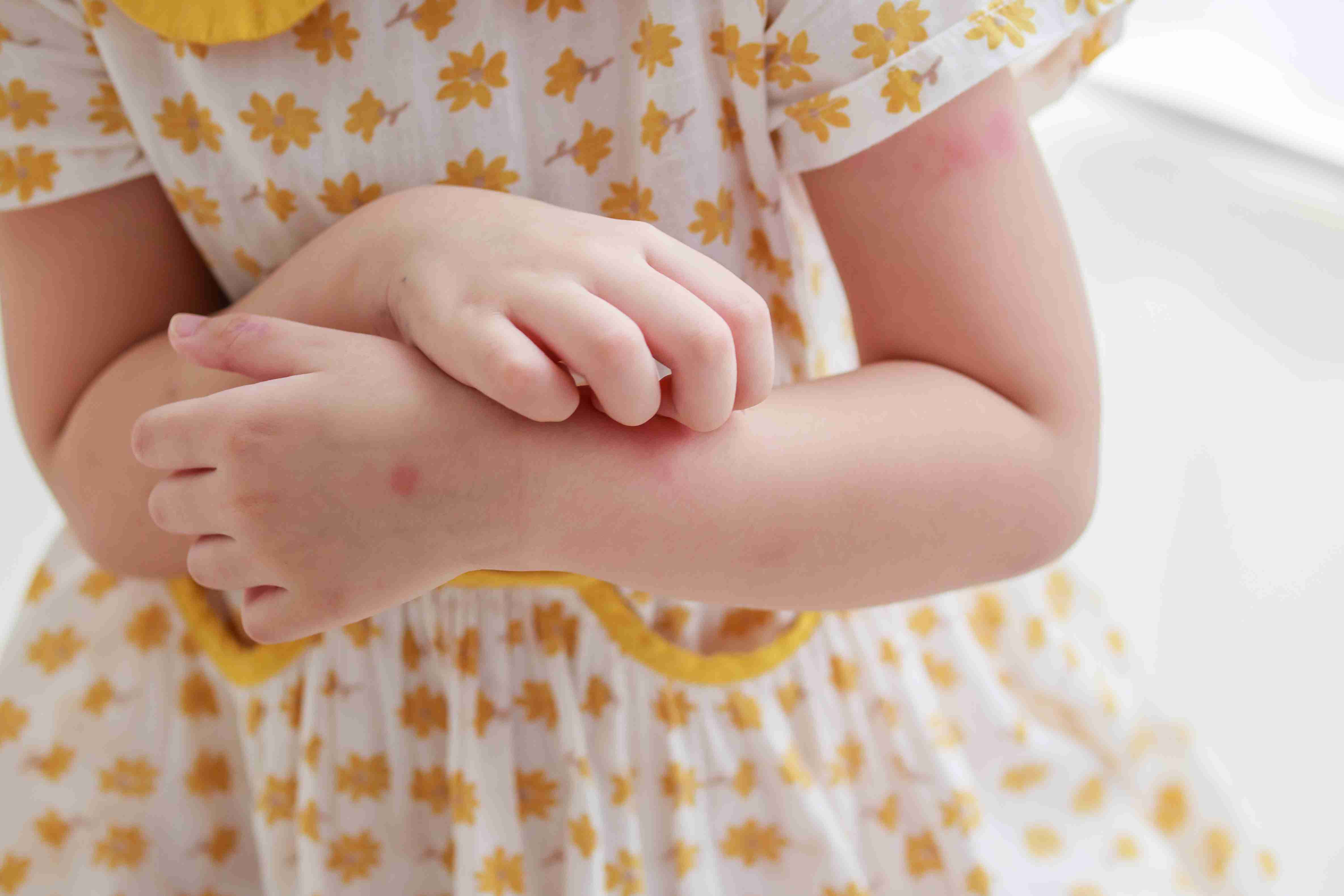 Antihistamine prescription for urticaria