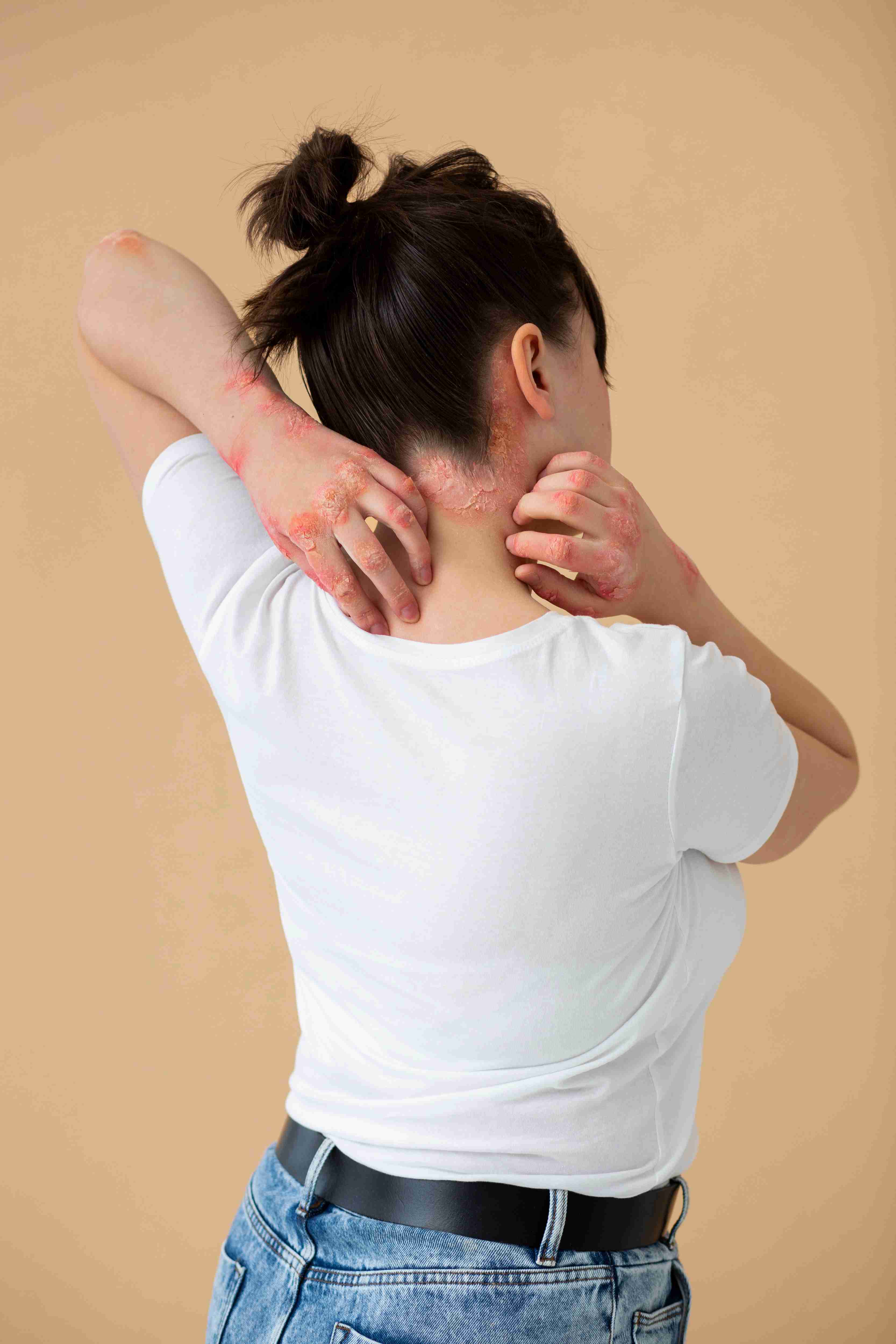 Steps to diagnose and manage urticaria