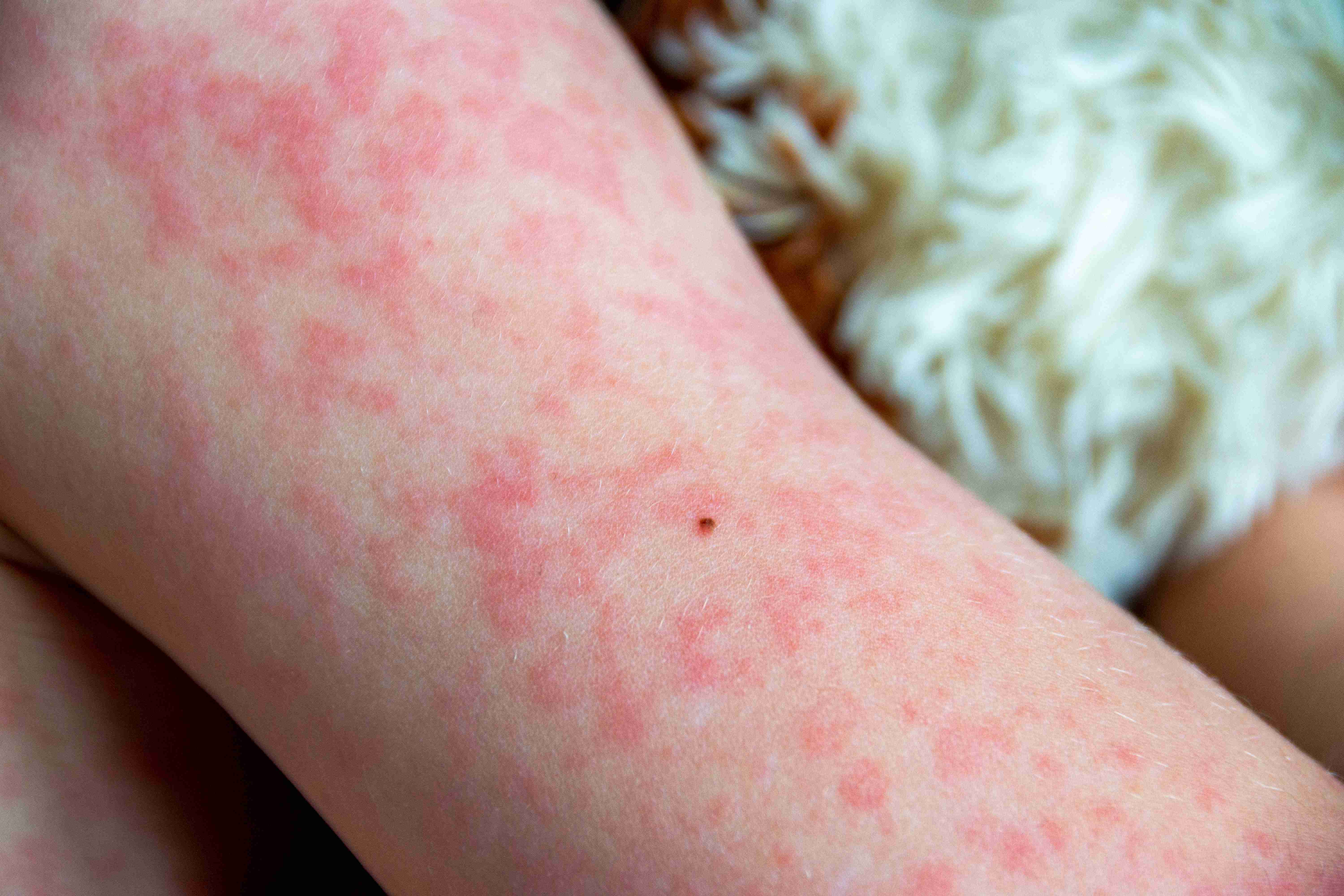 Before and after urticaria treatment