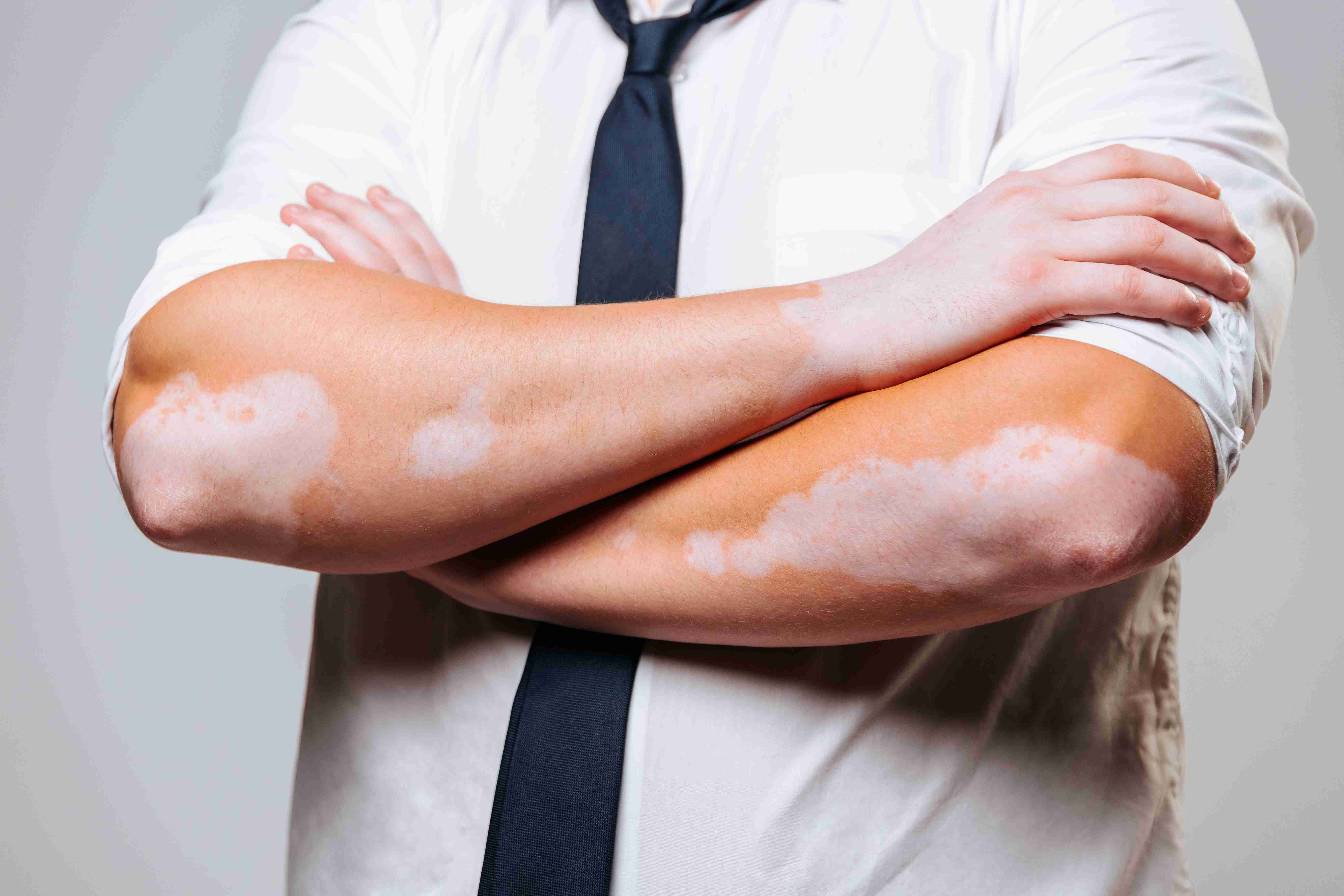 White patches around mouth and hands due to vitiligo
