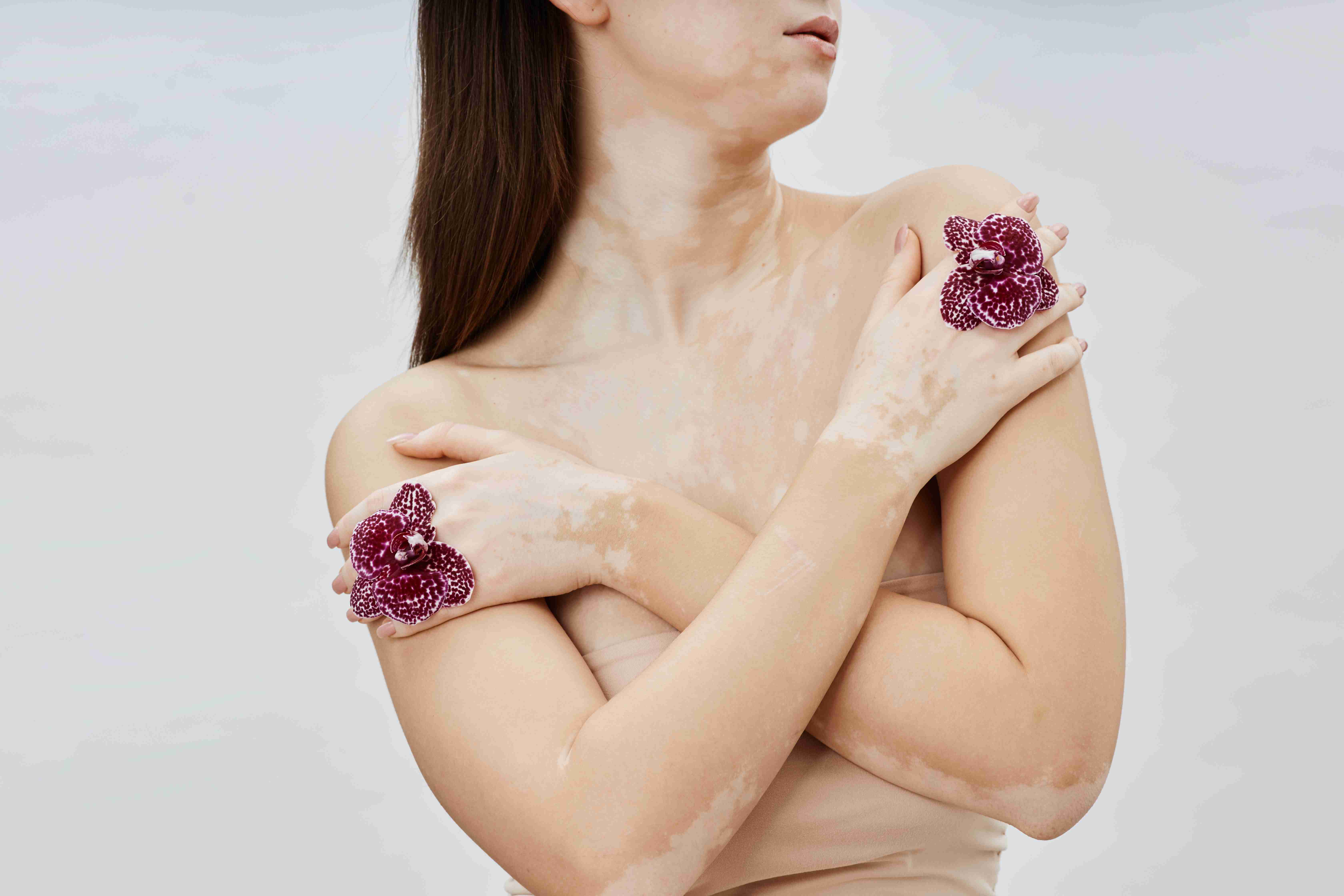 Autoimmune and genetic causes of vitiligo