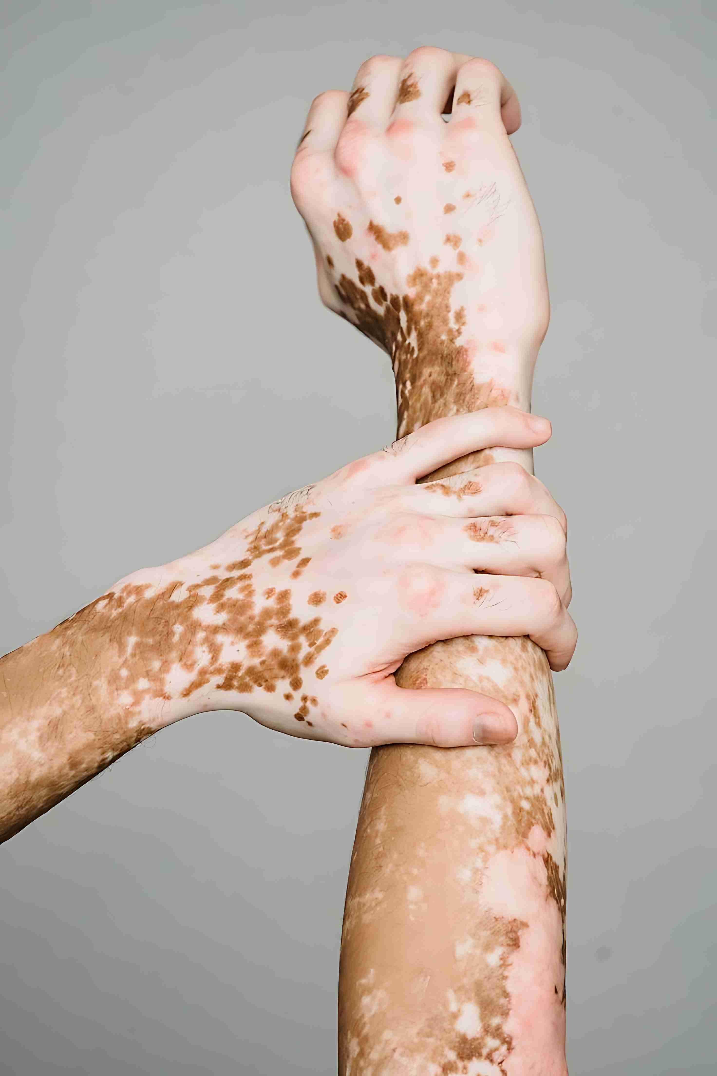 Types of vitiligo on different skin areas
