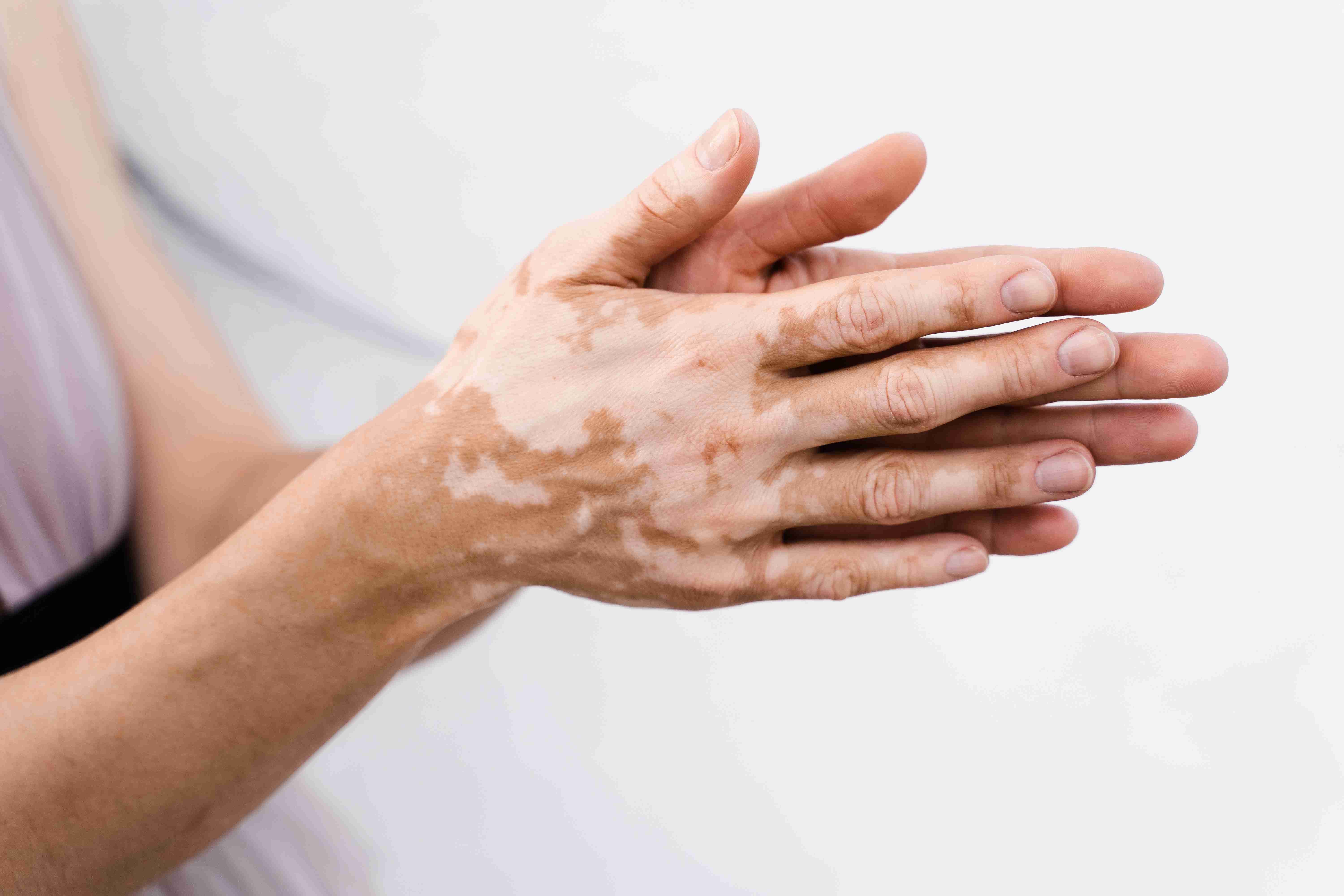 UV therapy and creams used to treat vitiligo